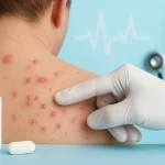 ivermectin scabies